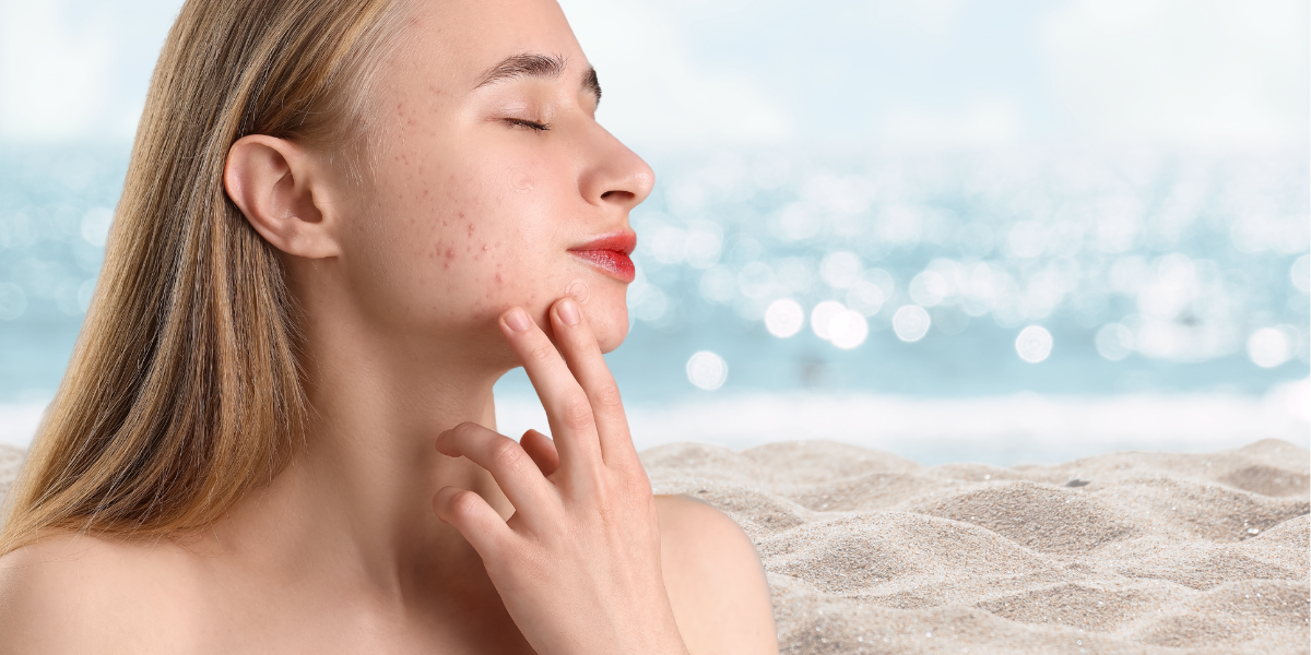 Los efectos del verano y el sol sobre el acné