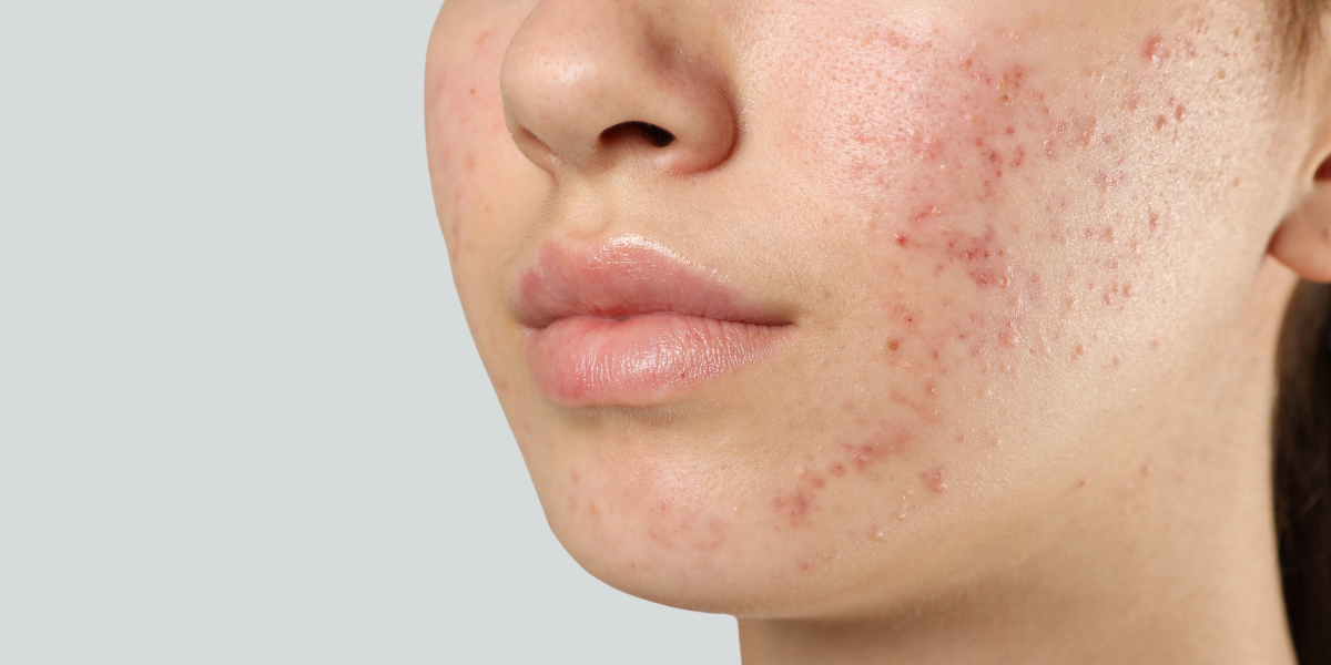 Línea de productos específicos para eliminar el acné