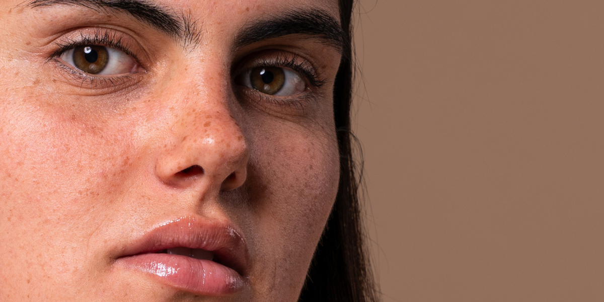 Manchas post verano: qué funciona realmente para difuminarlas